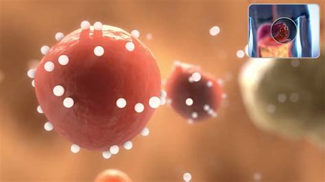 Treatment of Hyperphosphatemia In CKD - YouTube