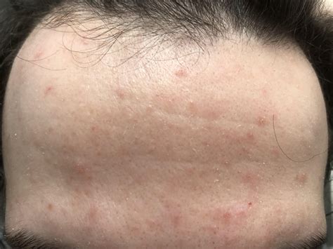 Itchy red spots on forehead with itchy scalp. Rosacea, psoriasis ...