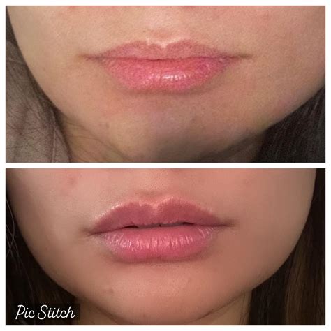 1st time lip filler - 1 syringe juvederm ultra! : r/PlasticSurgery