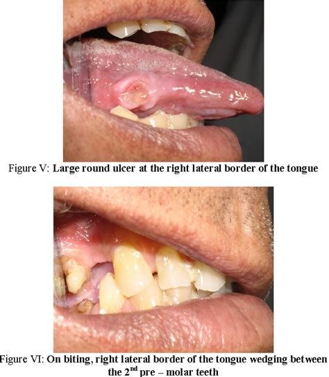 ulcer  tongue