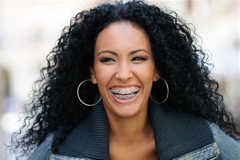 braces   adult baywood dental group