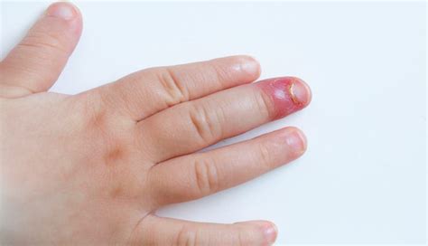 Bebê Com Dedo Inchado E Vermelho - Fungo No Dedo Micose No Pé: Saiba O Que é, Como Surge E Como Tratar