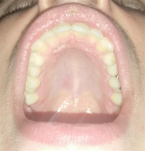 how to treat sore roof of mouth 5