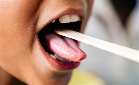 Everything You Need to Know About Geographic Tongue | by Princeview ...