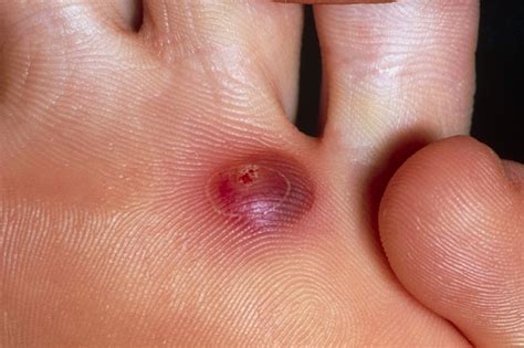Blisters | Wetenschap