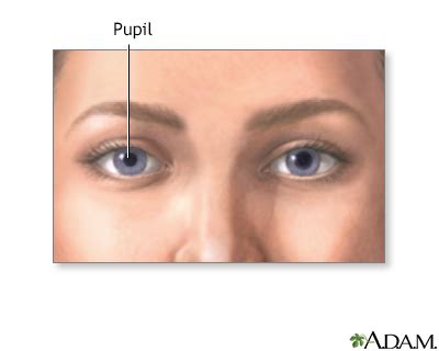 Anisocoria Information | Mount Sinai - New York