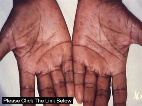 Gonorrhea symptoms in mouth - famegilit