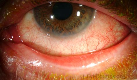 follicular  papillary conjunctivitis