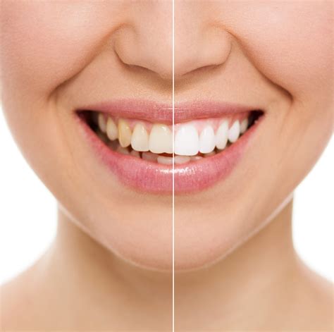 How to Use Crest White Strips (Step-by-Step Instructions)