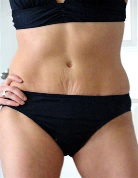 What to expect when recovering from a mommy makeover – Artofit