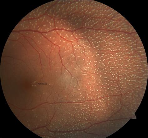 fundus albipunctatus retinara