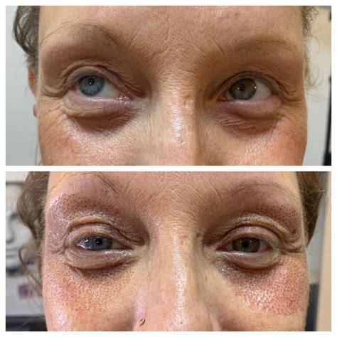 Plasma Fibroblast Under Eye Treatment Reliable Supplier | www