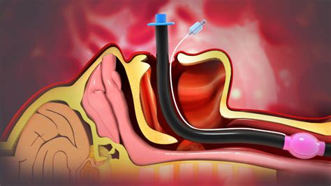 Why do we Intubate? - Critical Care Practitioner