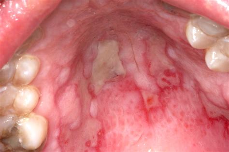 Erythema multiforme