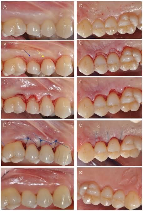 modified widman flap  dr gourav sharma  painless dentist shivpuri