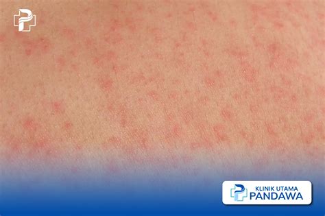 membedakan campak  alergi   perlu diketahui klinik pandawa