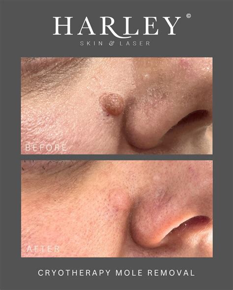 Harley - Before & After: Cryotherapy Mole Removal ️ A quick, effective