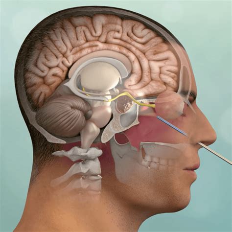 Pituitary Apoplexy | Pacific Pituitary Disorders Center