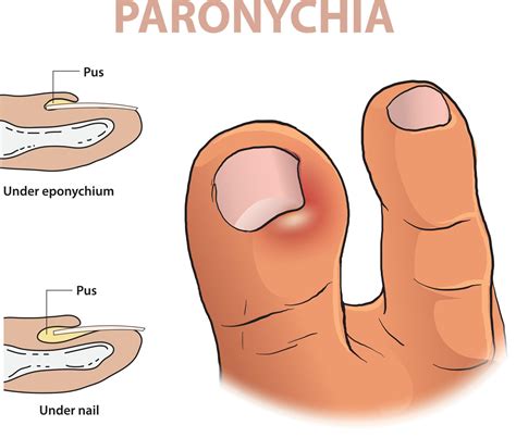 inforaphic illustration of paronychia in a toe 23087875 Vector Art at