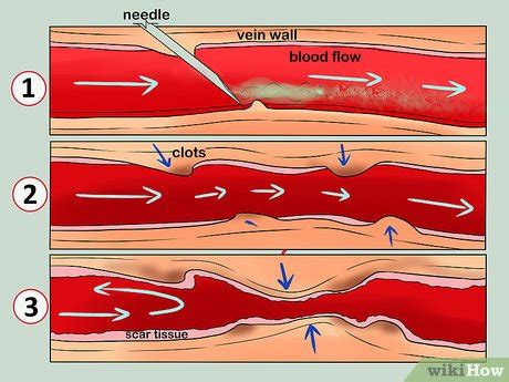 Collapsed Vein