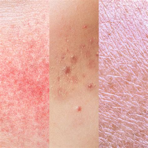 redness  sensitivity