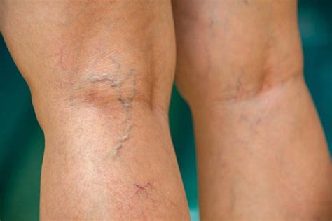 Blue Veins: What Causes Veins To Be More Visible and How to Treat Them