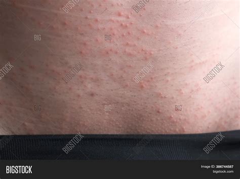 eczema  groin eczema  tinea cruris symptoms treatment gumre