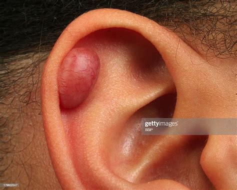 Keloid Scar, Ear piercing keloid. News Photo - Getty Images