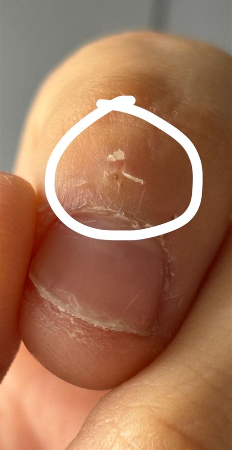 Paranoid verruca question : r/Warts