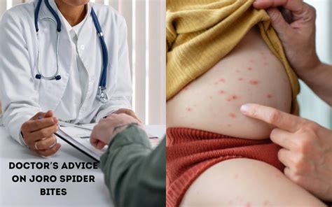 Joro Spider Bite: Symptoms, Treatment With Pictures