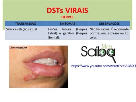 Herpes Labial E Dst - DSTs