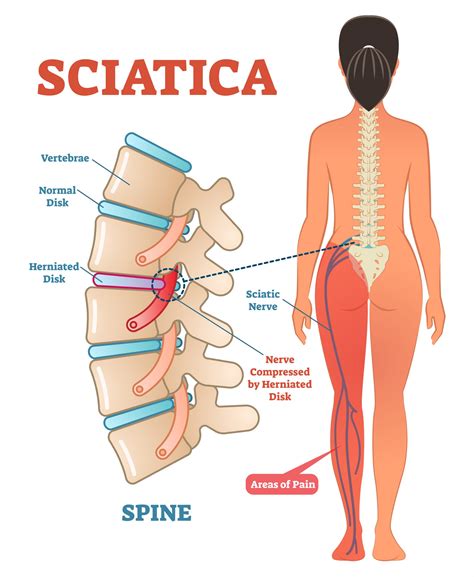 Differential Diagnosis Of Radicular Pain — Physio Network