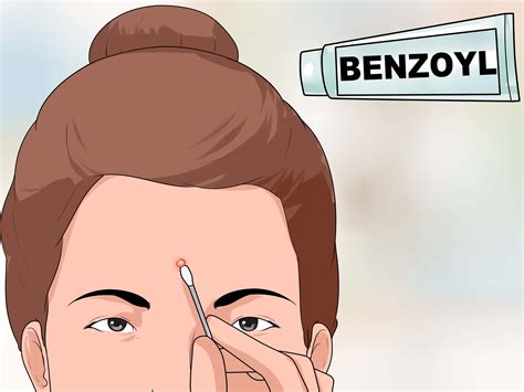 How to Pop a Pimple: 10 Steps (with Pictures) - wikiHow