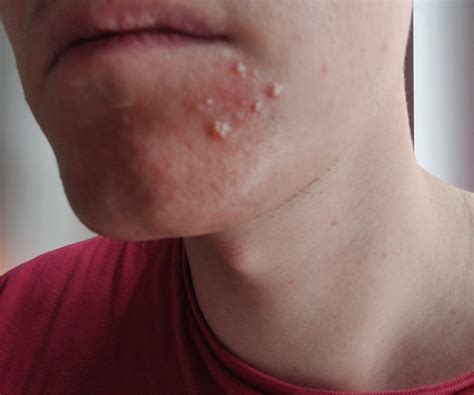 [Skin Concerns] Small everday recurring Pustules - Maybe Combination of