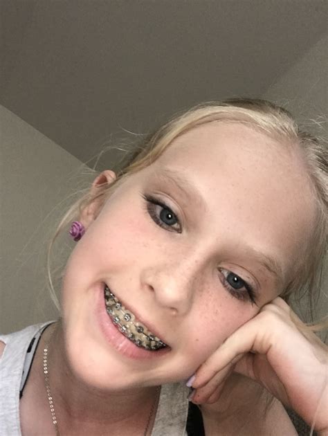 I am really happy | Beautiful freckles, Braces girls, Blonde hair girl