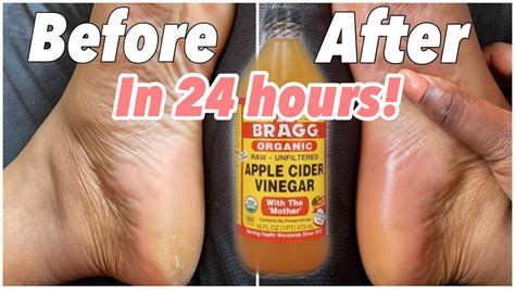 Listerine And White Vinegar Foot Soak Recipe | Deporecipe.co