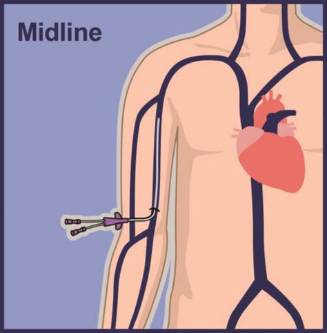 Peripheral IVs and PIVs | Vascular Wellness