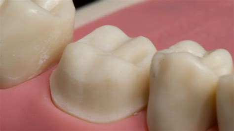 molar metal crown prep ccc   person perspective youtube