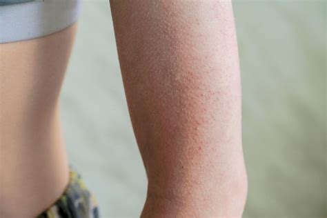 Hyperkeratosis: Treatment, Causes, Symptoms, Types