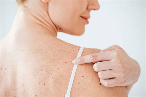Видове бенки | Как да разпознаем опасните | Dr. Denkova