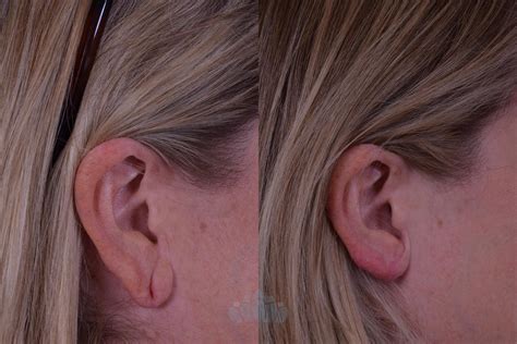 Earlobe Repair Before and After Pictures Case 58 | Charlotte, NC ...