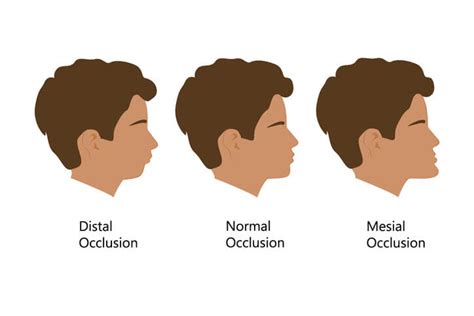 Prognatismo E Retrognatismo - O que é prognatismo e retrognatismo? - Instituto Maxilo Facial