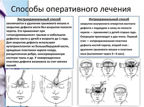Врожденные черепно - мозговые грыжи - online presentation
