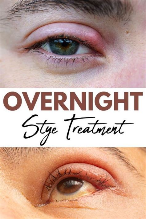 how to remove stye at home