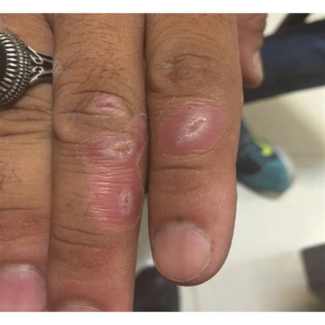 ulcers healed  weeks   start   treatment