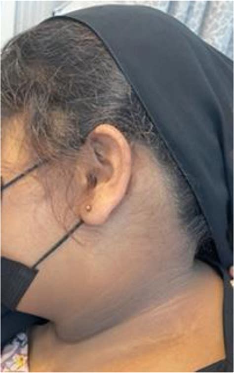 Patient photo showing acanthosis nigricans on the neck. | Download ...