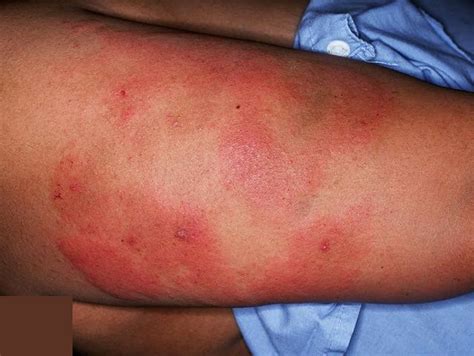 thrombotic thrombocytopenic purpura pictures
