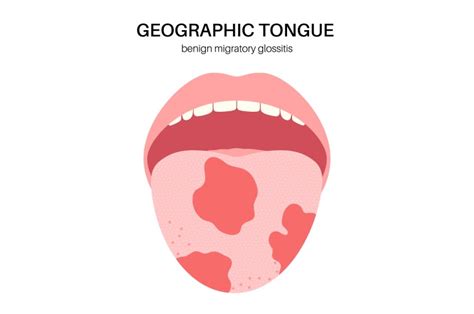tongue coating white yellow royalty  vector vectorstock