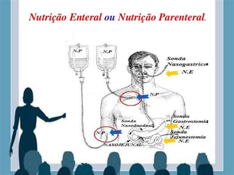 O Que É Nutrição Parenteral - NUTRIÇÃO PARENTERAL E NUTRIÇÃO ENTERAL