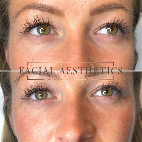 Dermal Fillers | Your Skin Secrets